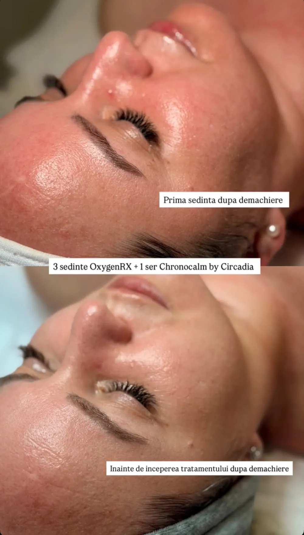 Înainte și după: 3 ședințe OxygenRX + 1 ser Chronocalm by Circadia