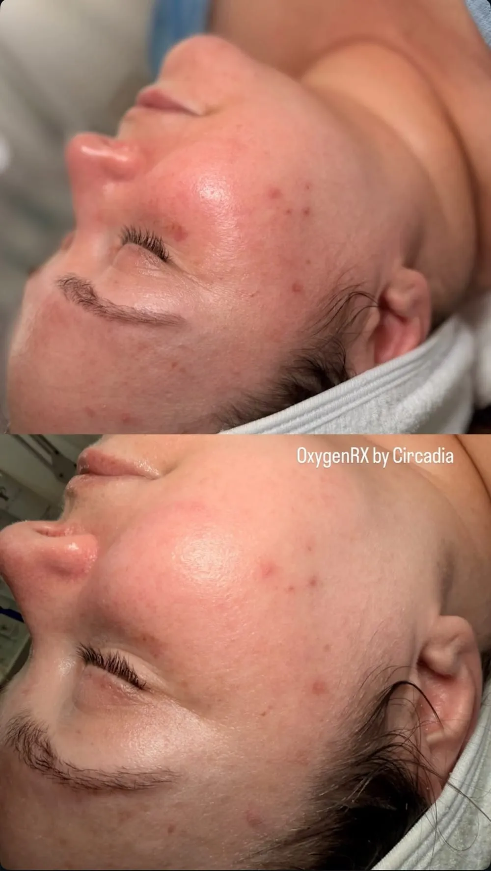 Înainte și după: OxygenRX by Circadia