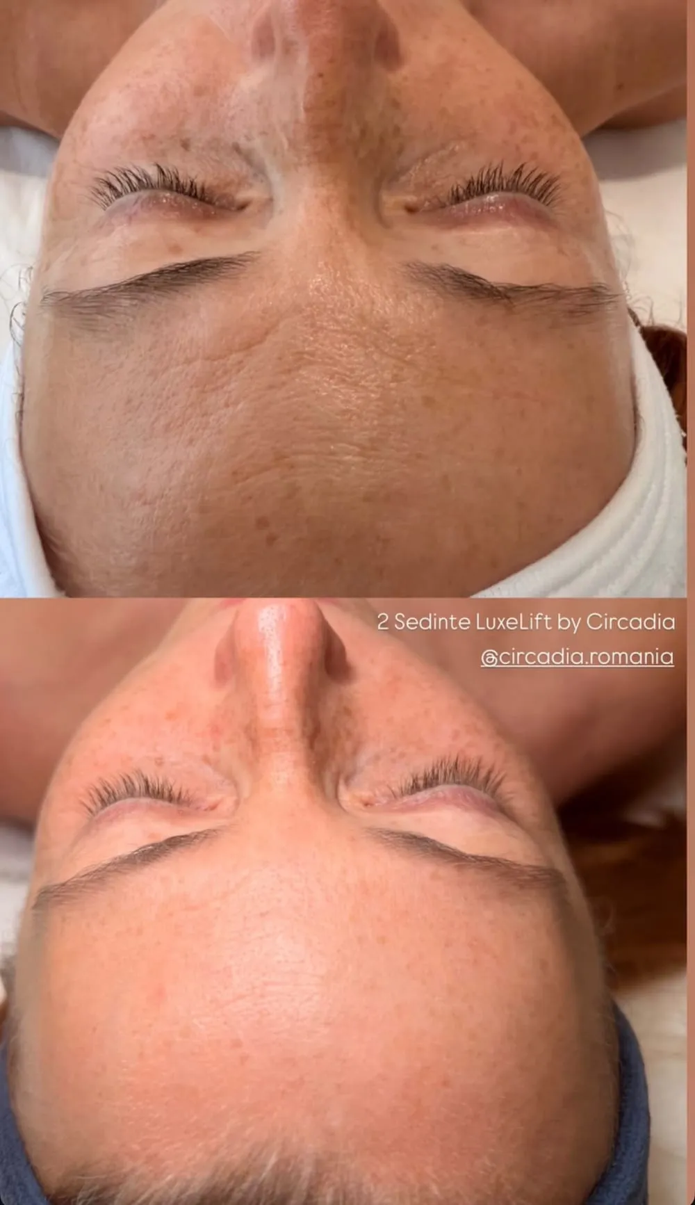 Înainte și după: 2 ședințe Luxe Lift by Circadia