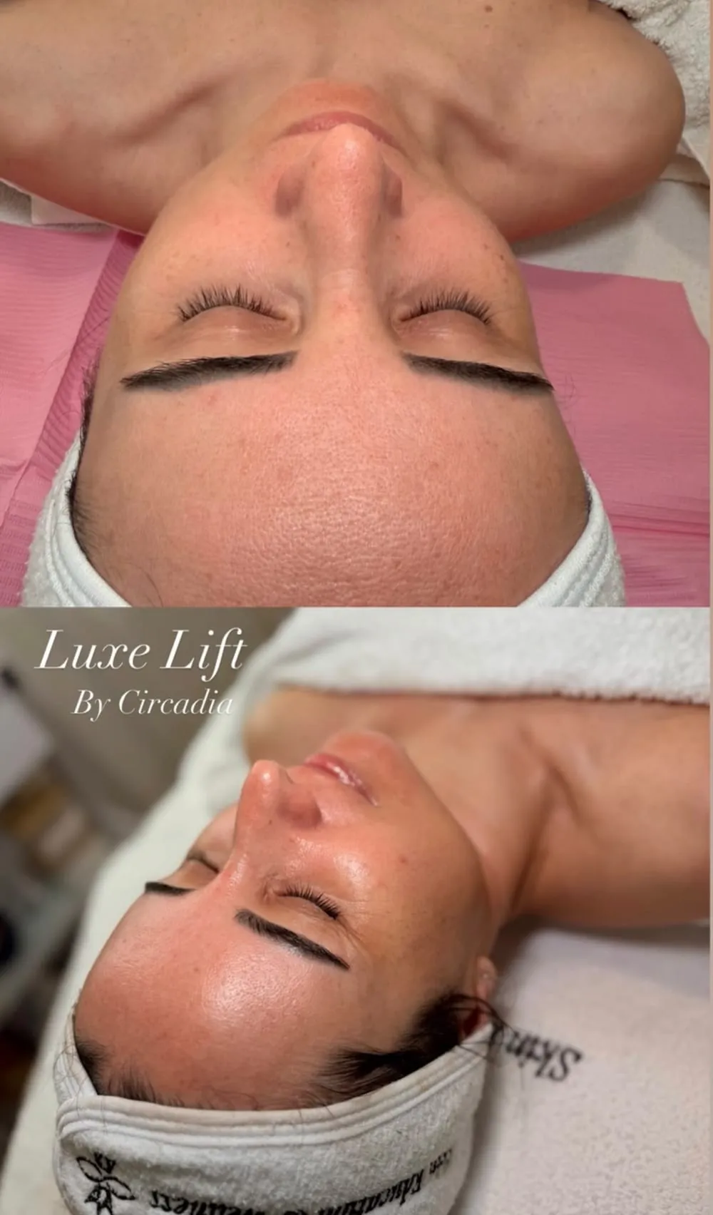 Înainte și după: Luxe Lift by Circadia