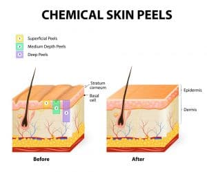 Peeling chimic